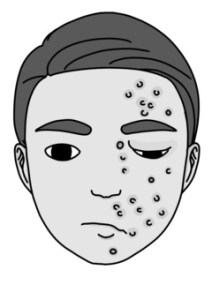 Drawing of a male with shingles on half of his face, the swelling closing his eye.