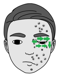 Drawing of a male with shingles on half of his face, the swelling closing his eye. Arrows indicate the direction direct pressure should be used, as per the instructions above.